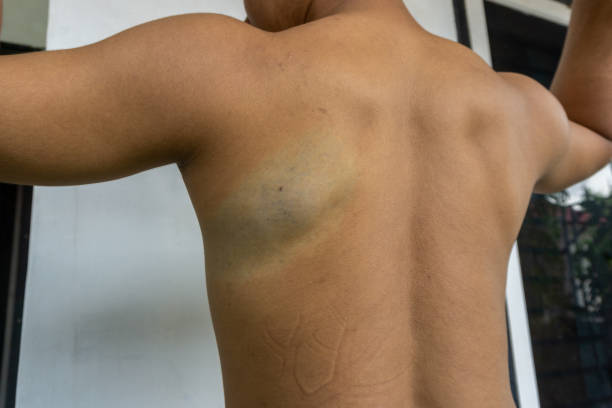 istock Scar on man body after laser tattoo removal 1694724794