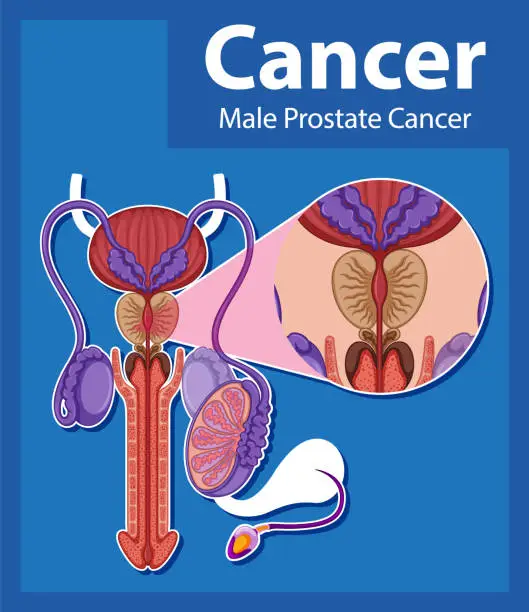 Vector illustration of Comparing Normal and Cancerous Prostate in Male Anatomy