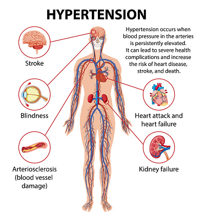 Illustrated infographic explaining how hypertension impacts various parts of the human body