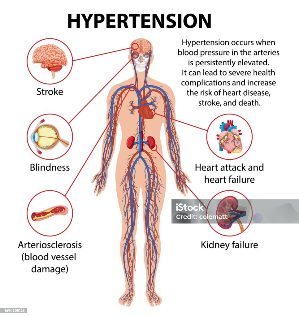 Science Education On Hypertensions Effects On Human Anatomy Stock science-education-on-hypertensions-effects-on-human-anatomy-stock