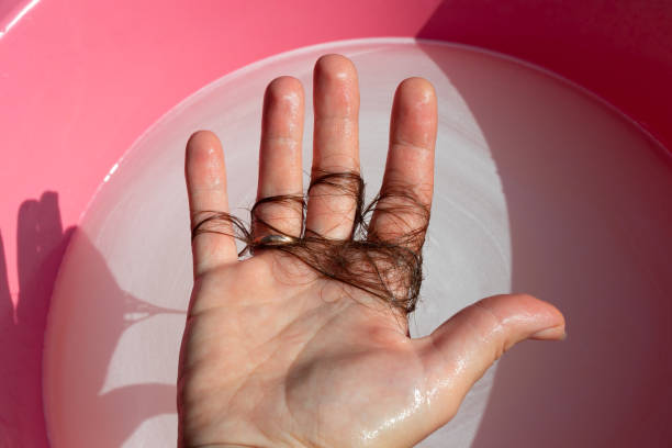 Hair on a woman's white hand after washing her hair in the shower. Alopecia - hair loss problem stock photo