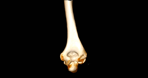 istock CT scan of elbow joint 3d rendering  showing humerus bone. 1695052176