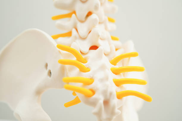 istock Spinal nerve and bone, Lumbar spine displaced herniated disc fragment, Model for treatment medical in the orthopedic department. 1695588177