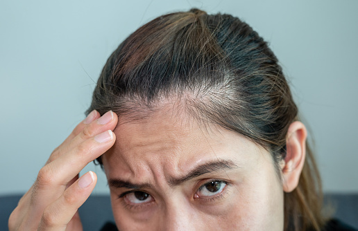 Female pattern hair loss can progress from a widening part to overall thinning.