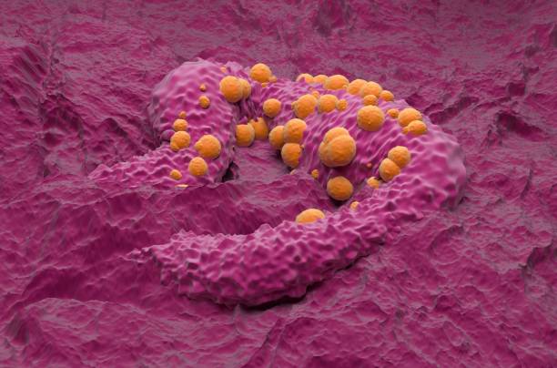 Basal-cell carcinoma (BCC) - isometric view 3d illustration