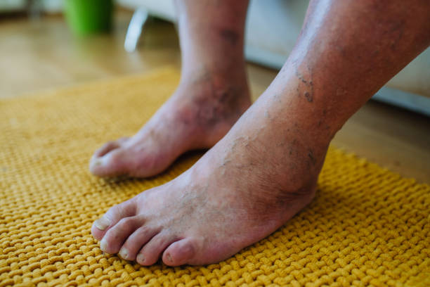A close-up shot of man's feet with diabetic foot complications. stock photo
