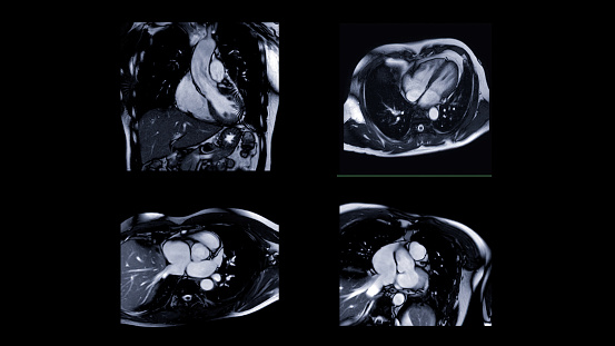 MRI heart or Cardiac MRI ( magnetic resonance imaging ) of heart  for detecting heart disease.