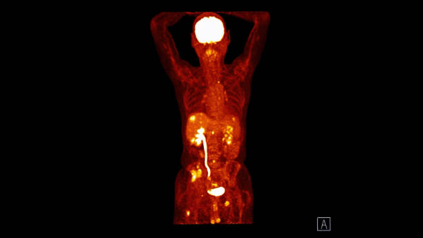 istock PET CT image of Whole human body  coronal plane. Positron Emission Computed Tomography . 1697071513