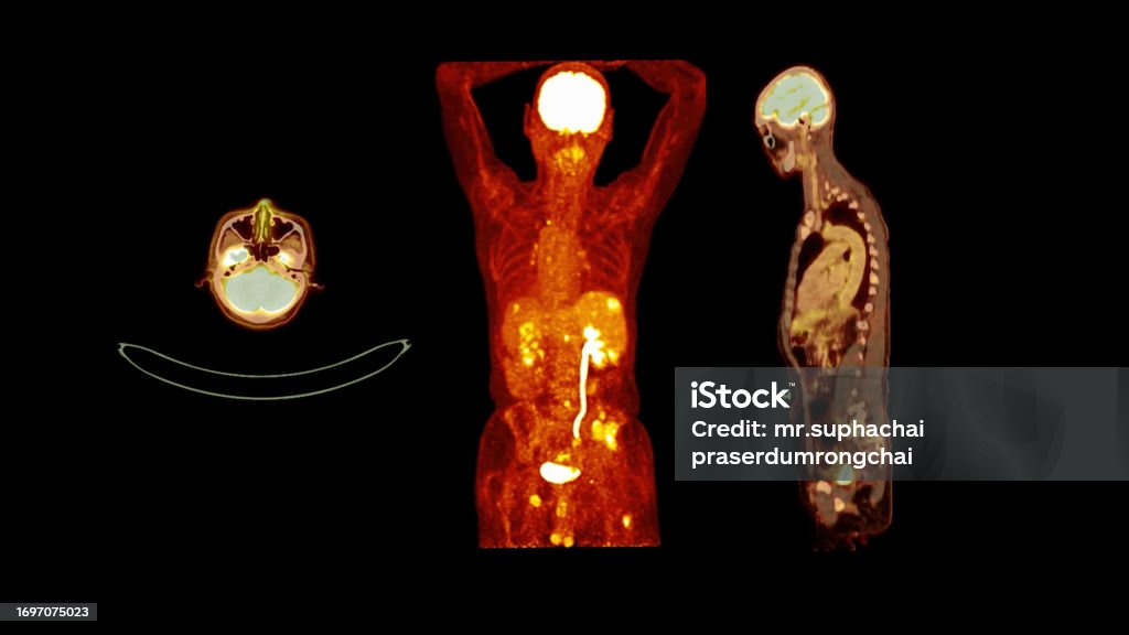 Gambar Pet Ct Dari Seluruh Tubuh Manusia Bidang Aksial Koronal Dan Biology Diagrams