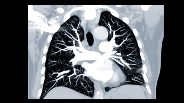 CTPA or CTA pulmonary artery for diagnostic Pulmonary embolism (PE) , lung cancer and covid-19. . CTPA or CTA pulmonary artery for diagnostic Pulmonary embolism (PE) , lung cancer and covid-19. . pulmonary artery stock pictures, royalty-free photos & images