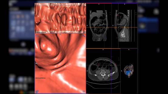 La colonografía por TC compara la imagen 2D axial, sagital, coronal y 3D para la detección del cáncer colorrectal. Para chequeos de salud anuales para detectar cáncer de colon. photo