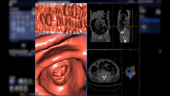 La colonografía por TC compara la imagen 2D axial, sagital, coronal y 3D para la detección del cáncer colorrectal. Para chequeos de salud anuales para detectar cáncer de colon. photo