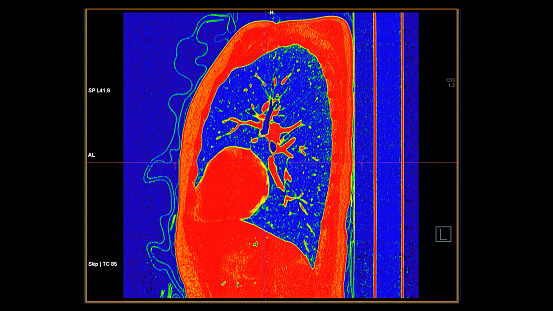 CT scan of Chest coronal view in color mode  for diagnostic Pulmonary embolism (PE) , lung cancer and covid-19.