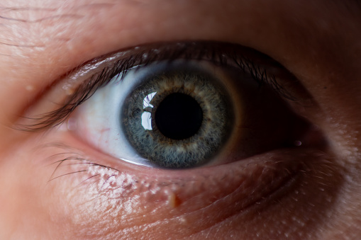 close up of the senile cataract during eye examination,