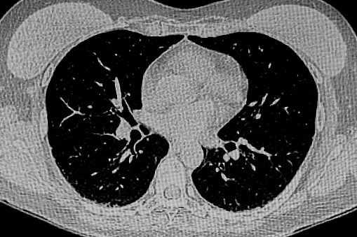 Axial CT scan through the thorax after intravenous contrast showing the complications which may occur with asbestos exposure. There is extensive left pleural thickening and left pleural fluid due to advanced mesothelioma. Bilateral pleural plaques, some calcified on the left are also seen.
