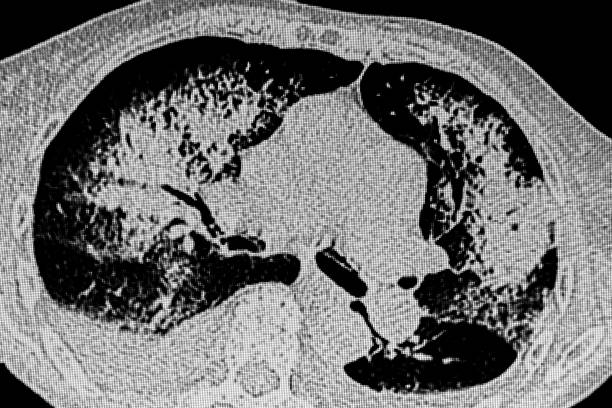 istock Cat Scan of bilateral lung infection and right pleural effusion 1699239639