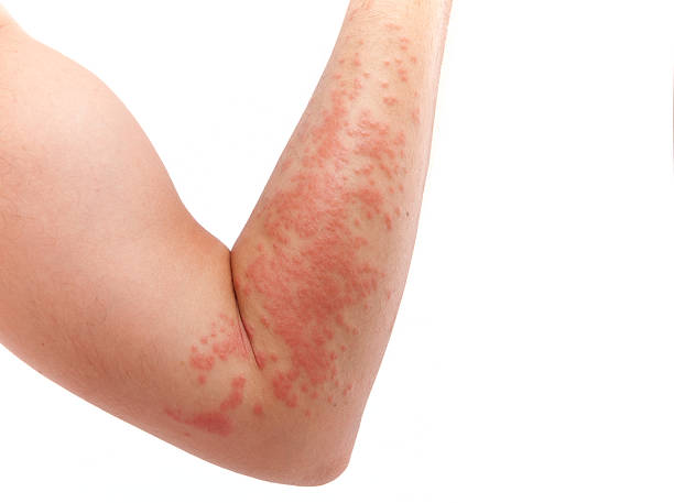 Skin allergy Arm covered in a skin allergy,hives dermatitis photos stock pictures, royalty-free photos & images