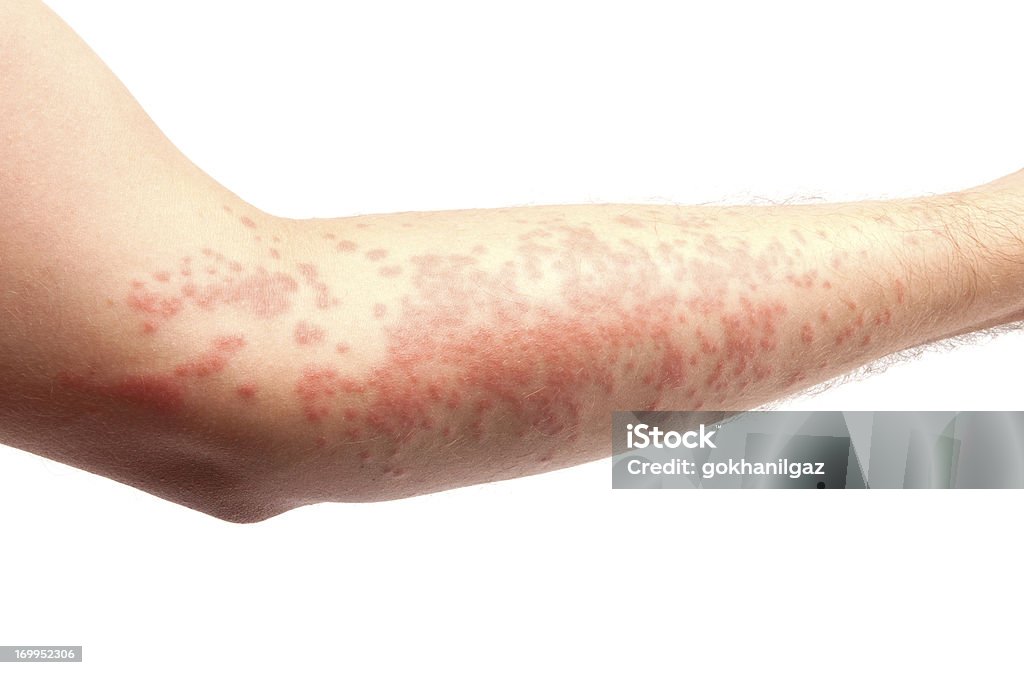 Tratamiento de la piel - Foto de stock de Urticaria libre de derechos