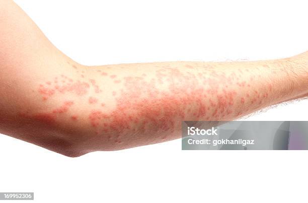 피부 알레르기 두드러기-피부 상태에 대한 스톡 사진 및 기타 이미지 - 두드러기-피부 상태, 피부 상태, 습진