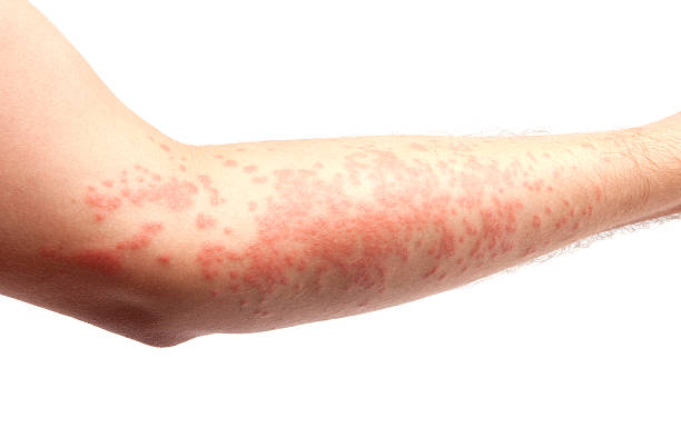 skin allergy arm covered in a skin allergy,hives skin condition photos stock pictures, royalty-free photos & images