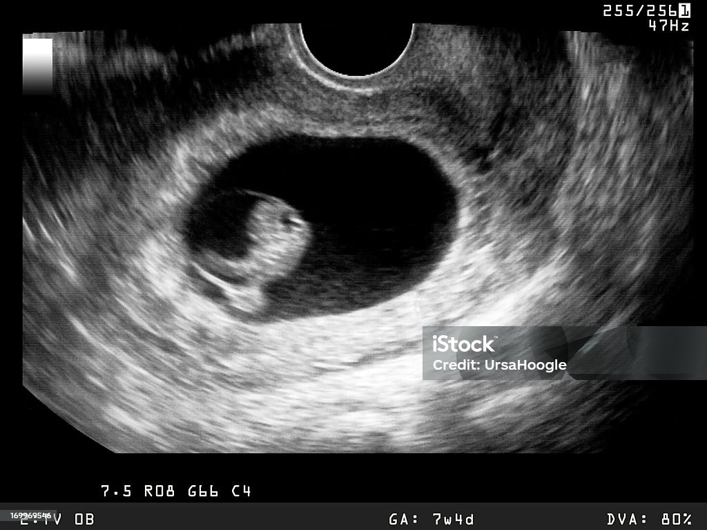 USG z wczesnym etapie rozwoju zarodka - Zbiór zdjęć royalty-free (Embrion)