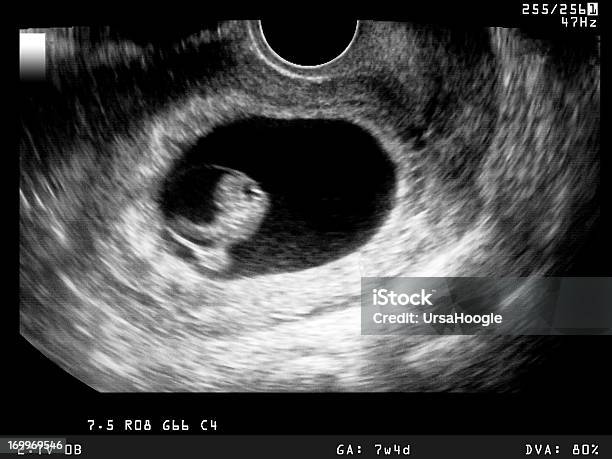 Usg Z Wczesnym Etapie Rozwoju Zarodka - zdjęcia stockowe i więcej obrazów Embrion - Embrion, Ultradźwięk, Początki
