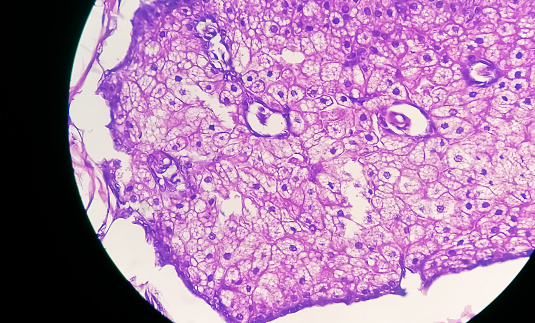 Photomicrograph of Invasive squamous cell carcinoma of the nipple, Grade-II