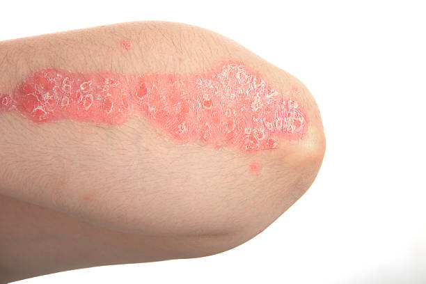 psoriasis - eczema photos et images de collection