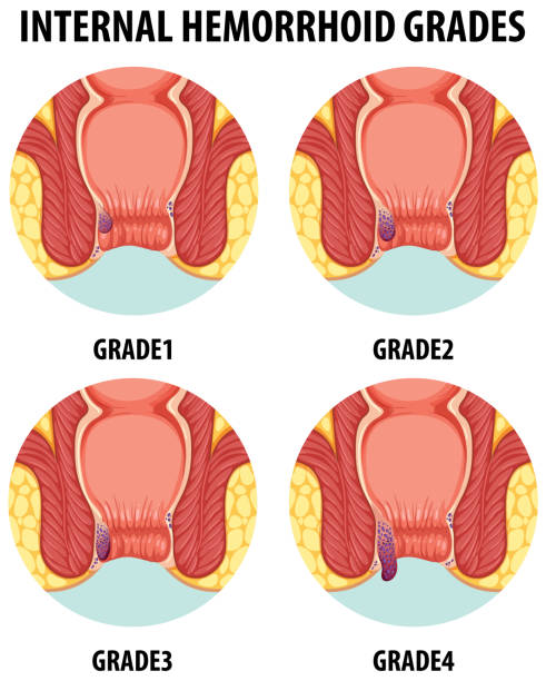 Anatomie illustrée des hémorroïdes internes humaines à différents degrés - Illustration vectorielle