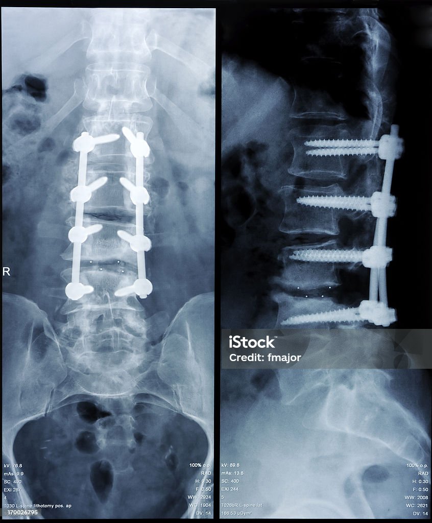 Spondylolisthesis Operated spondylolisthesis.. Spine - Body Part Stock Photo