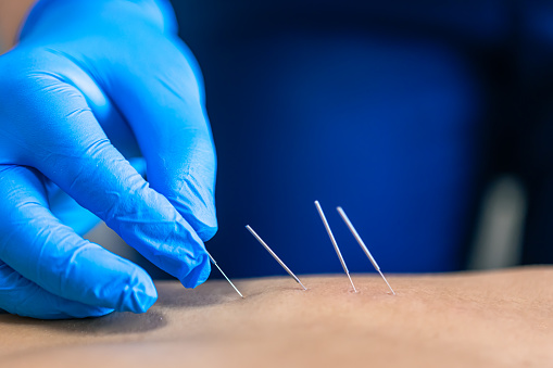 Close up of a needle and hands of physiotherapist doing a dry needling in a physiotherapy center.