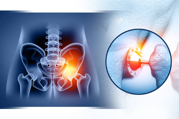 Hip implant, artificial joint. 3d illustration Hip implant, artificial joint. 3d illustration hip replacement stock pictures, royalty-free photos & images