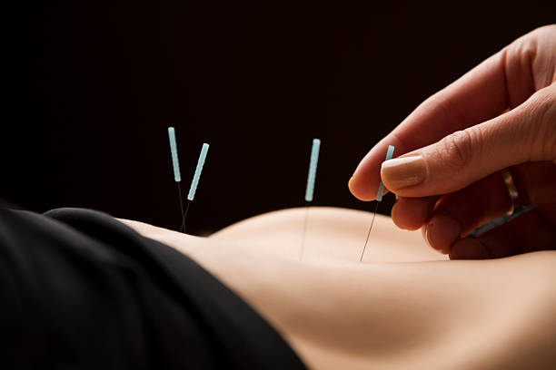 femme s'acupuncture soin au spa - acupuncture needle photos et images de collection