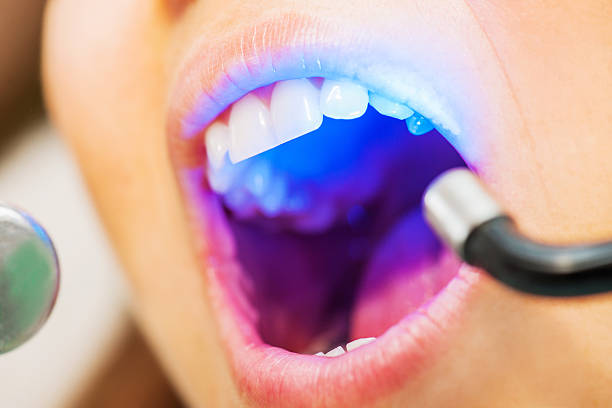 Ultraviolet dental treatment. Close-up of female patient having her teeth whitened.    medical laser photos stock pictures, royalty-free photos & images