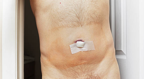 220 Belly Button Hernia Surgery Stock Photos Pictures Royalty Free 220-belly-button-hernia-surgery-stock-photos-pictures-royalty-free