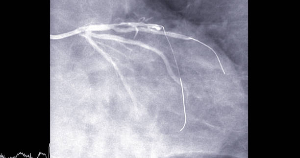 左前下行動脈(lad)の心臓カテーテル検査は、医師が心臓発作や脳卒中などの心臓や血管の問題を診断および治療するのに役立ちます。 - surgery catheter cardiac catheterization hospital ストックフォトと画像