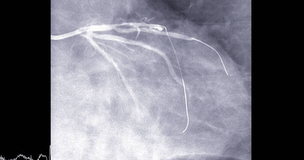 Cardiac catheterization on  left anterior descending artery (LAD) can help doctor diagnose and treat problems in your heart and blood vessels  such as a heart attack or stroke. stock photo