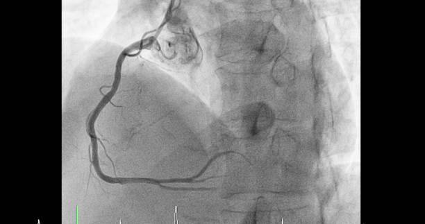 el cateterismo cardíaco en la arteria coronaria derecha (acr) puede ayudar al médico a diagnosticar y tratar problemas en el corazón y los vasos sanguíneos, como un ataque cardíaco o un accidente cerebrovascular. - surgery catheter cardiac catheterization hospital fotografías e imágenes de stock