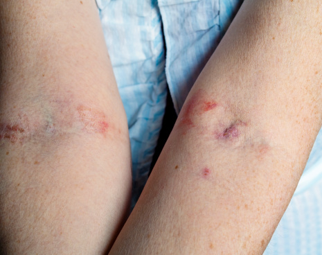The insides of a senior woman’s arms after a week of hospital treatment for a serious injury. Various cannulas were inserted into the veins and dressings applied, the latter causing an allergic reaction with weeping blisters. 