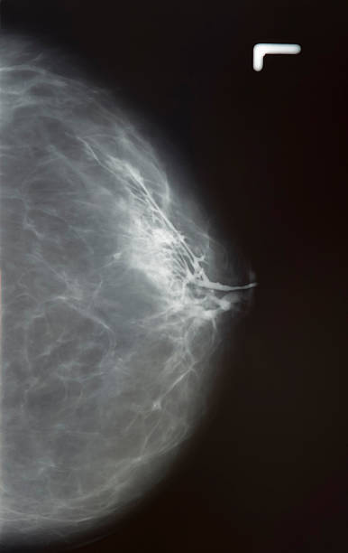 x-ray de mamma - lactiferous duct photos et images de collection