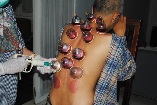 Indonesian Bekam is one of traditional treatment methods. Bekam or Hijama or Cupping is the local suction of blood from small skin incisions. Cupping is a treatment method by removing static blood containing toxins from the human body. Cupping involves vacuuming the skin and removing dirty blood from it. methodist stock pictures, royalty-free photos & images