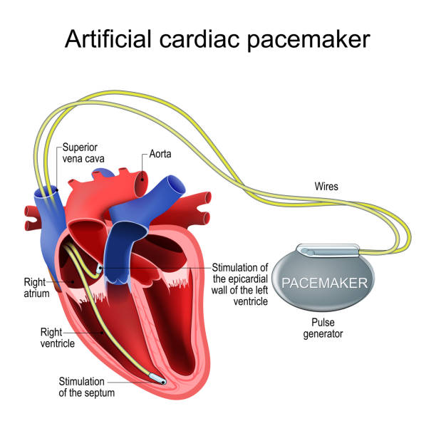 Artificial cardiac pacemaker. Heart implant. Artificial cardiac pacemaker. Heart implant. Treatment of a Bradycardia, Tachycardia, Arrhythmia. Cross section of a human heart with Pulse generator to stimulate the septum, and to pace the epicardial wall of the left ventricle. Dual-chamber pacemaker. Vector illustration septum stock illustrations