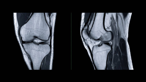 magnetresonanztomographie des kniegelenks oder mrt kniesagittal zur erkennung eines risses oder einer verstauchung des vorderen kreuzbandes (vkb). - cruciate ligament stock-fotos und bilder