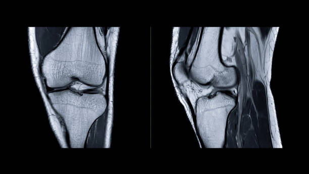 Magnetic resonance imaging of knee joint or MRI knee sagittal for detect tear or sprain of the anterior cruciate ligament (ACL). stock photo