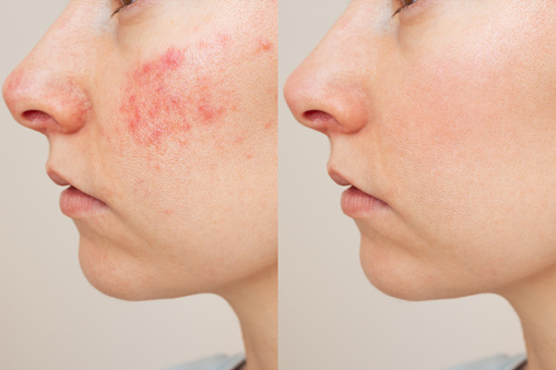 face comparison of a young Caucasian woman suffering from the skin chronic disease rosacea on her face in the acute stage. Before and after treatment. Pink acne. Dermatological problems.
