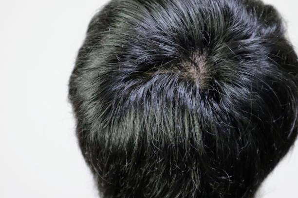 istock Close-up of a Japanese man's whorls 1704288438