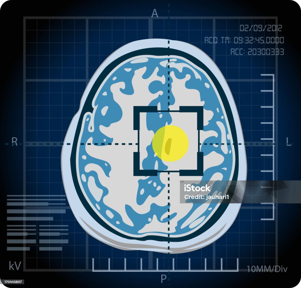 MRI – Lokalizacja - Grafika wektorowa royalty-free (Obrazowanie magnetyczno-rezonansowe)