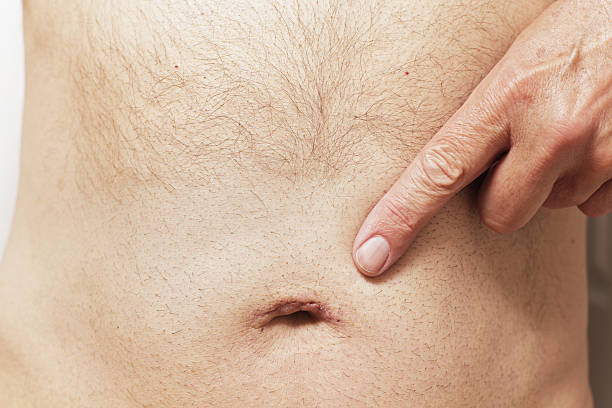 Man Pointing To Belly Button Scar About two weeks after umbilical hernia surgery, a senior man is pointing to his healing navel scar. The scab and almost all of the glue that held the incision together is gone, and body hair is growing back across the area where it was shaved prior to surgery. navel stock pictures, royalty-free photos & images