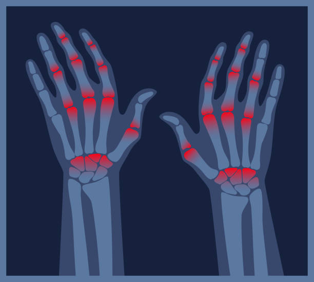 ilustrações de stock, clip art, desenhos animados e ícones de arthritis hands x-ray. pain in the human body. arthritis, bone disease medical poster. finger arthritis vector illustration. chronic skeleton pain, inflammation and autoimmune disorder - human bone the human body healthcare and medicine human skeleton