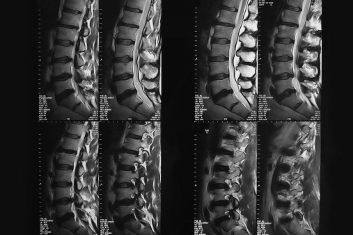 MRI of spinal column